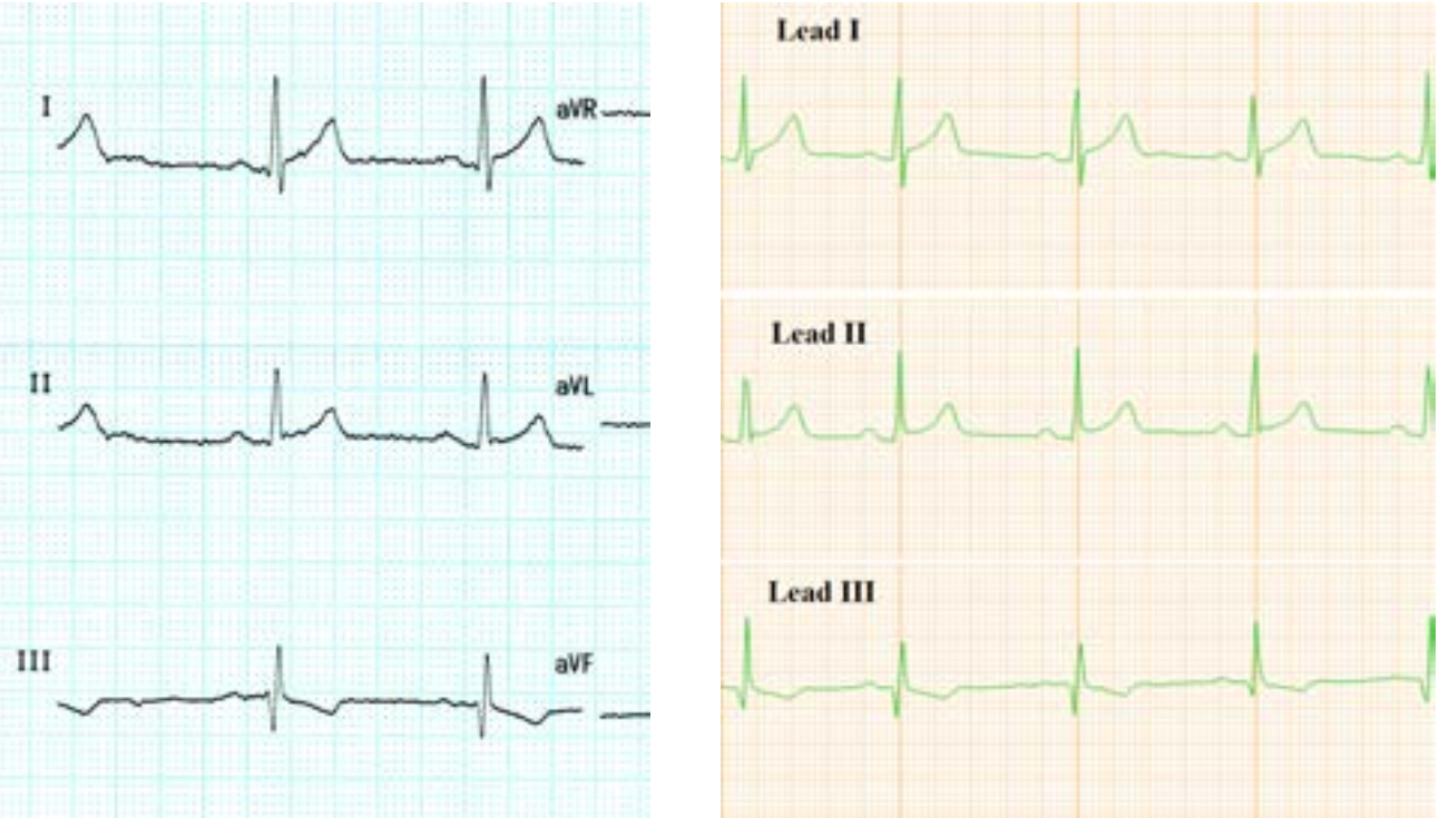 Comparison of ECG plot using traditional equipment (left) and AmbuSens (right)